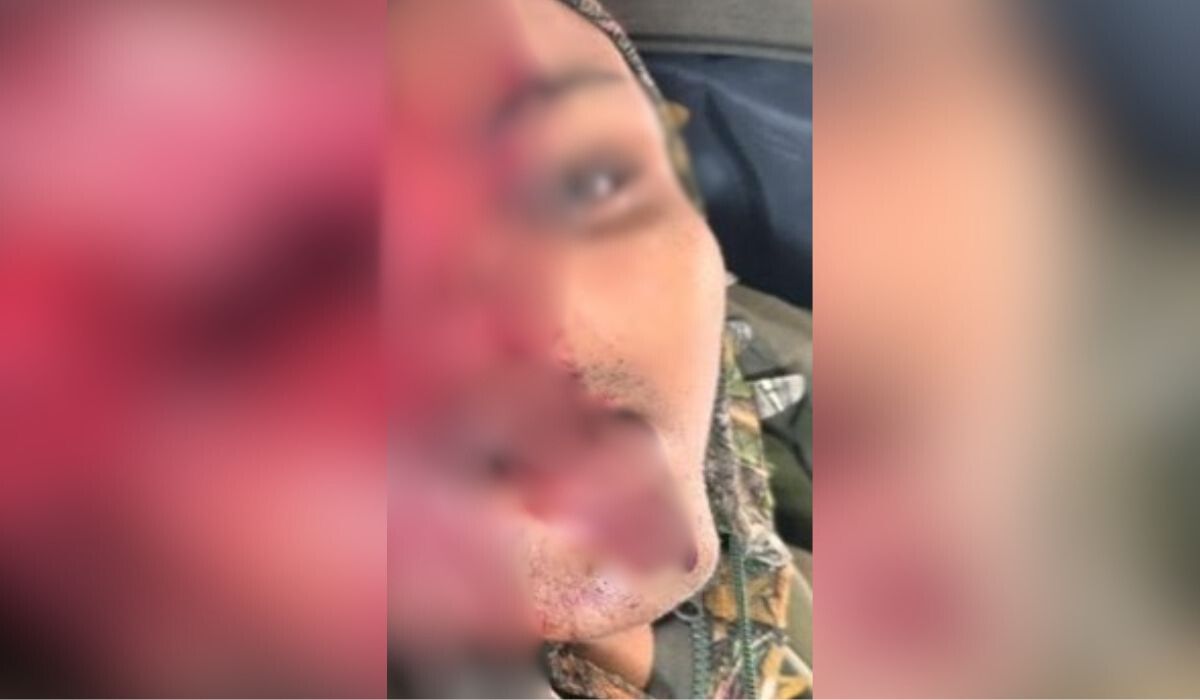 Foto de corpo com ferimento grave na face, resultado de um disparo de fuzil. A imagem, divulgada nas redes sociais, mostra o rosto parcialmente destruído, levantando dúvidas sobre a identidade da vítima.